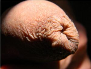 foreskin pucker