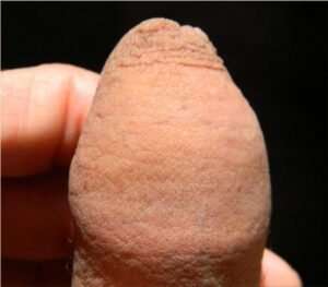 restored foreskin tip