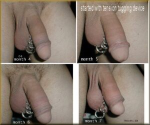 Foreskin restoring results 7 months