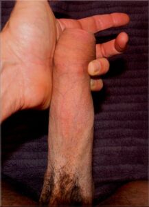 restored foreskin pull