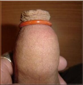 o-ring on foreskin