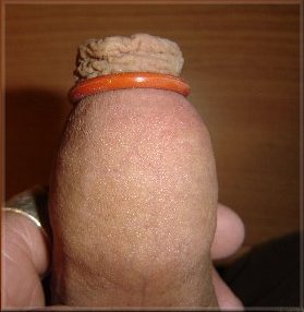 o-rings on end of foreskin