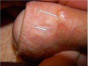 old foreskin piercing scar