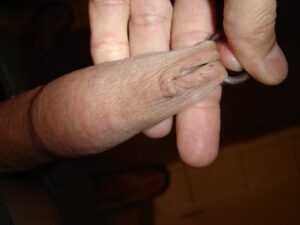 Foreskin ring pull