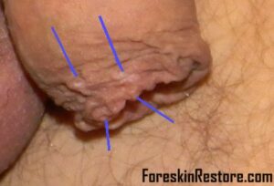 foreskin edge