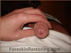 Alex foreskin 2