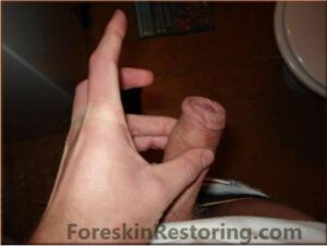 Alex foreskin