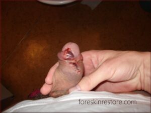 foreskin restoring touch up 2