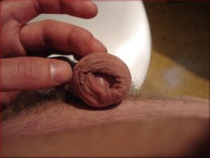 foreskin restoring touch up 7