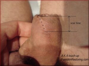 foreskin restoring touch up 8