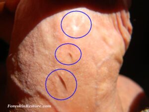 healed foreskin piercings