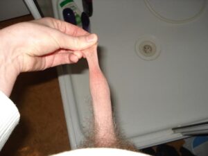Foreskin purse string touch up 12