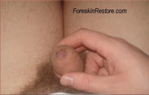 Foreskin purse string touch up 9