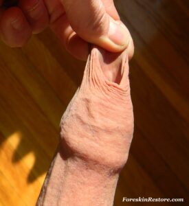 foreskin restoration pull