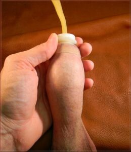 Foreskin restoring balloon method 9