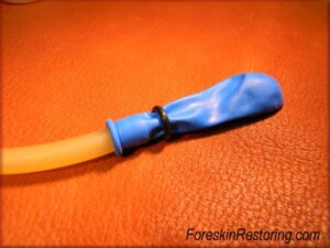 Foreskin restoring balloon method 4